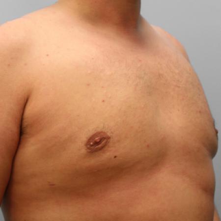 After image 2 Case #107721 - Gynecomastia Sugery