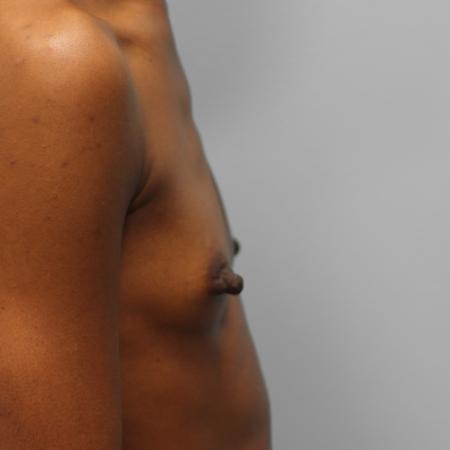 Before image 3 Case #108096 - Breast Augmentation