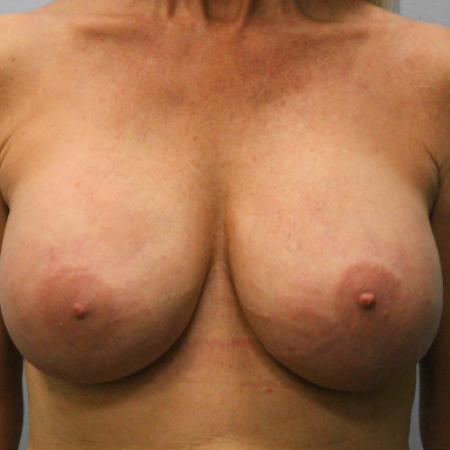 After image 1 Case #107821 - Breast Revision