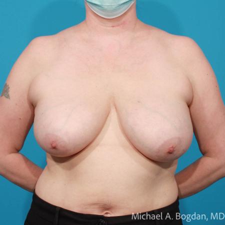 Before image 1 Case #108311 - Breast Lift