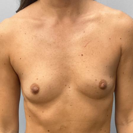Before image 1 Case #108126 - Breast Augmentation