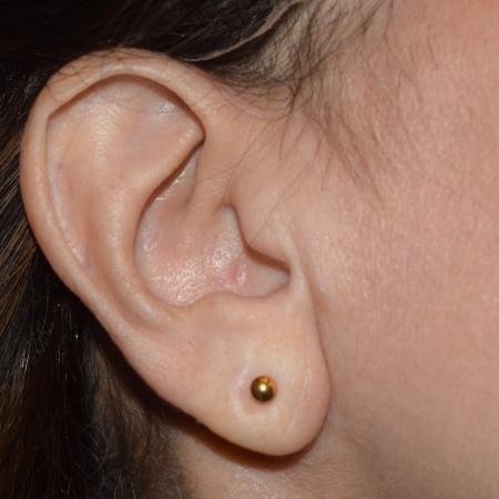 After image 1 Case #107916 - Earlobe Repair + Piercing