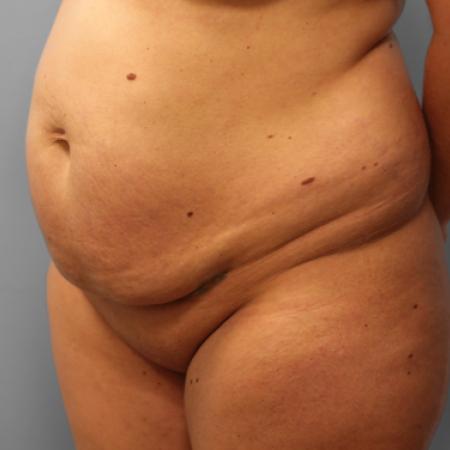 Before image 2 Case #108051 - Tummy Tuck