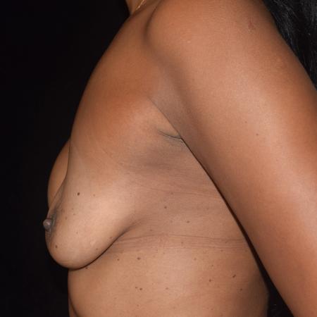 Before Case #107891 - Endoscopic Breast Augmentation Revision