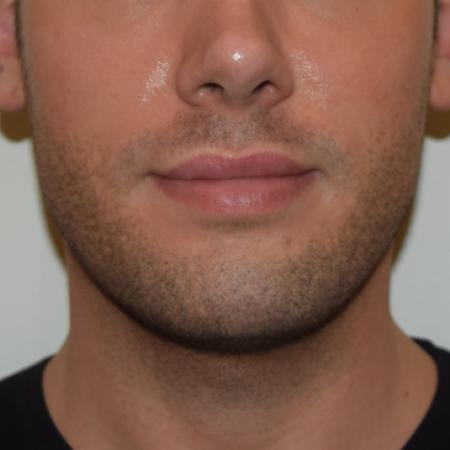 After image 1 Case #107881 - Male Facial Contouring with Morpheus8