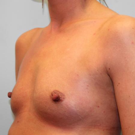 Before image 2 Case #107606 - Breast Augmentation