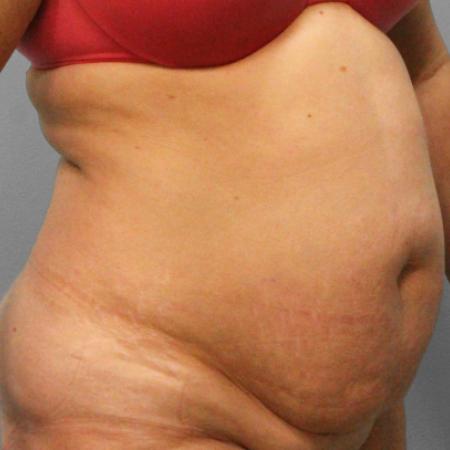 Before image 2 Case #107801 - Tummy Tuck