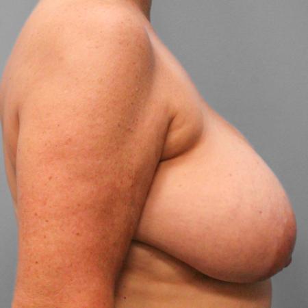 Before image 3 Case #107816 - Breast Reconstruction
