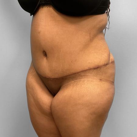 After image 2 Case #108136 - Tummy Tuck & BBL