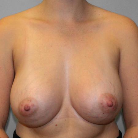 After image 1 Case #107741 - Breast Augmentation
