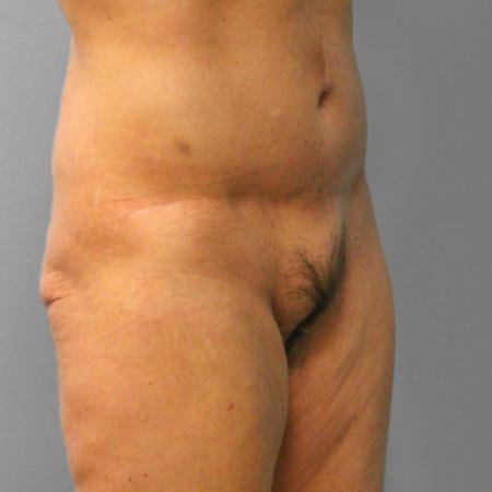 After image 2 Case #107546 - Tummy Tuck