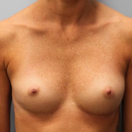 Before image 1 Case #107951 - Breast Augmentation