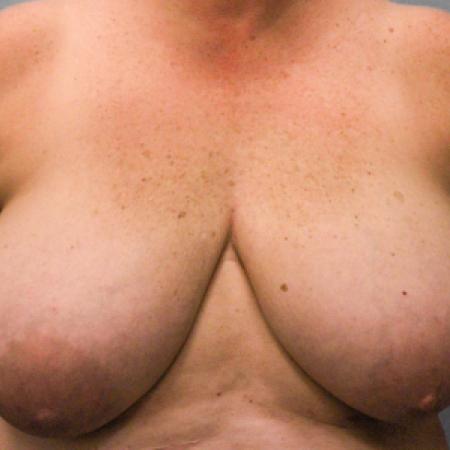 Before image 1 Case #107816 - Breast Reconstruction