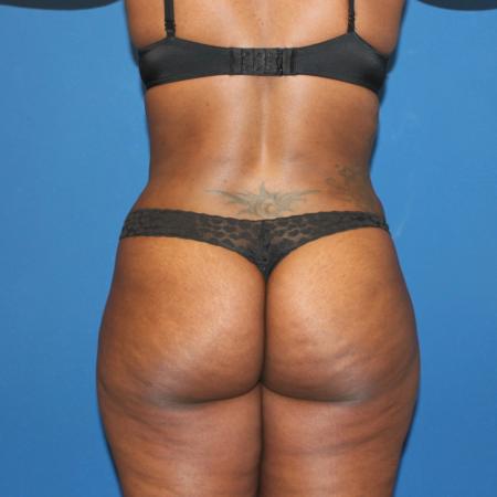 After image 4 Case #107521 - Mommy Makeover