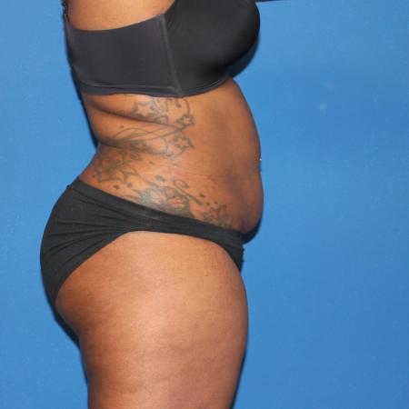 Before image 3 Case #107521 - Mommy Makeover