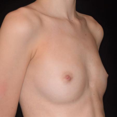 Before image 3 Case #107901 - Underarm Endoscopic Breast Augmentation