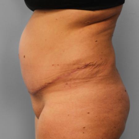 After image 3 Case #108051 - Tummy Tuck