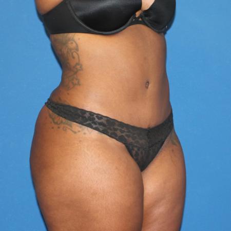 After image 2 Case #107521 - Mommy Makeover