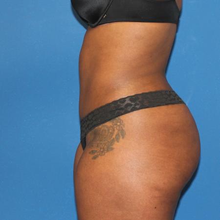 After image 5 Case #107521 - Mommy Makeover