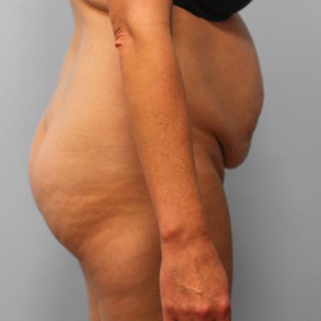 Before image 3 Case #107656 - Tummy Tuck