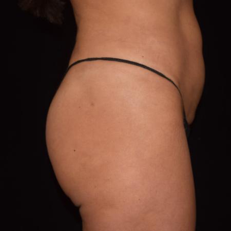 After image 4 Case #107886 - Female Liposuction & Fat Transfer