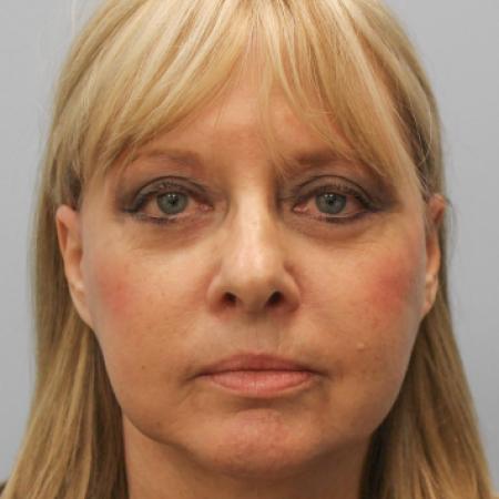 After image 1 Case #108151 - Facelift & Blepharoplasty