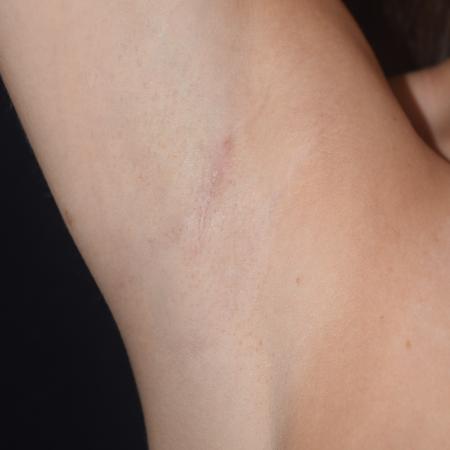 After image 4 Case #107901 - Underarm Endoscopic Breast Augmentation