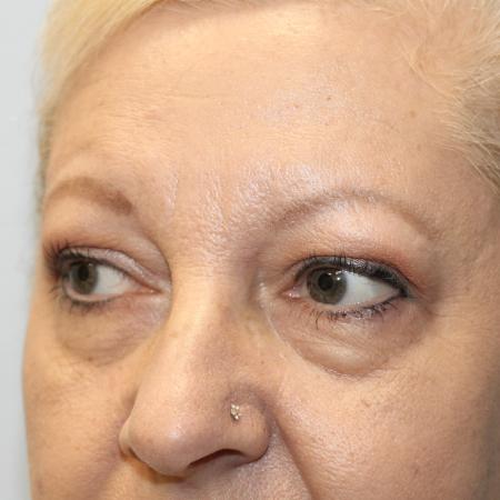 Before image 2 Case #108211 - Blepharoplasty