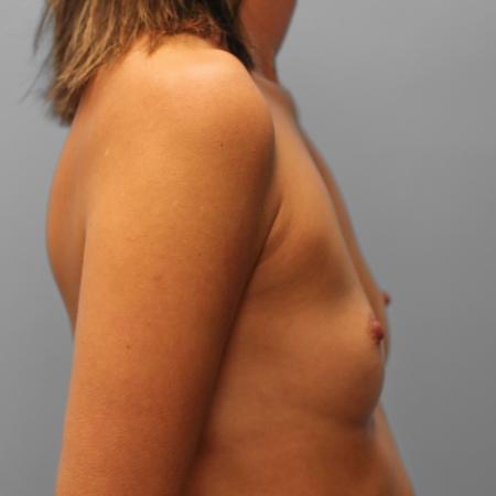Before image 3 Case #108091 - Breast Augmentation