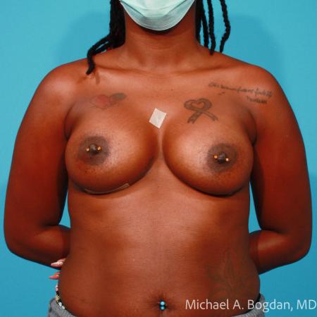 After image 1 Case #108346 - Breast Augmentation