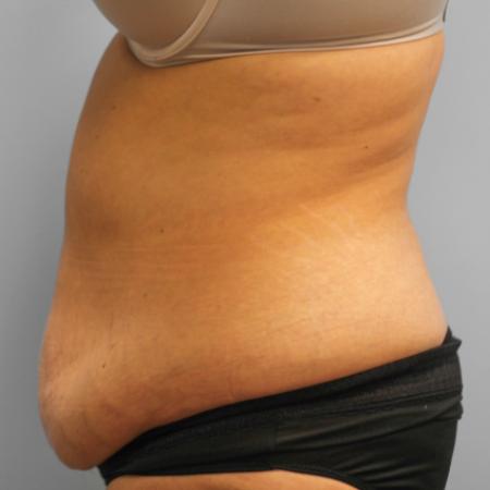 Before image 3 Case #108076 - Tummy Tuck
