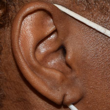 Ear Surgery Plastic Surgery Photos