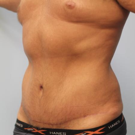 After image 2 Case #107581 - Tummy Tuck