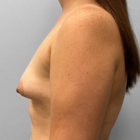 Before image 3 Case #107621 - Breast Augmentation