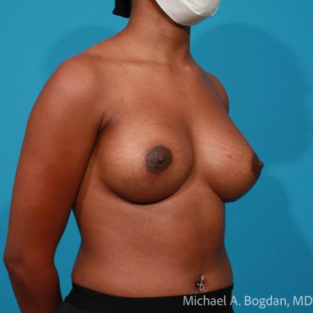 After image 2 Case #108351 - Breast Augmentation