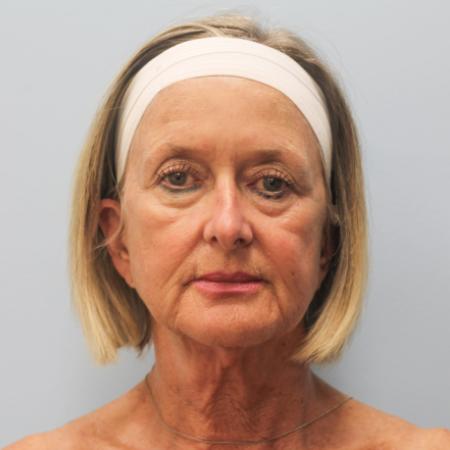 Before image 1 Case #108171 - Facelift, Browlift, & Blepharoplasty