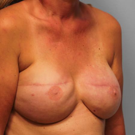Before image 2 Case #108061 - Breast Revision