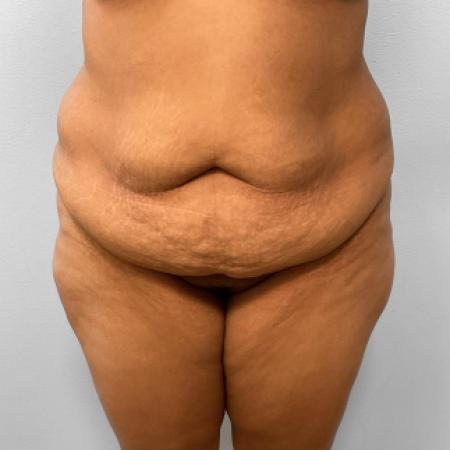 Before image 1 Case #108136 - Tummy Tuck & BBL
