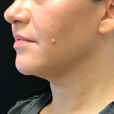 Before image 4 Case #108011 - CoolSculpting for Double Chin