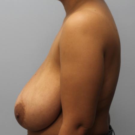 Before image 3 Case #108186 - Breast Reduction