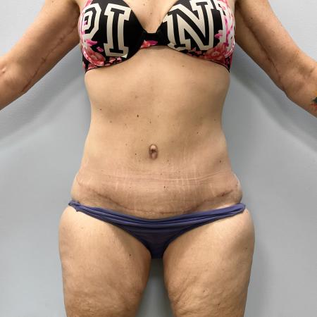After image 1 Case #108161 - Tummy Tuck & Arm Lift