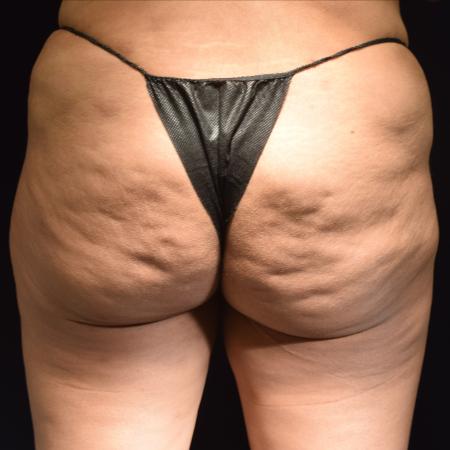 Before Case #107931 - Avéli® Cellulite Treatment