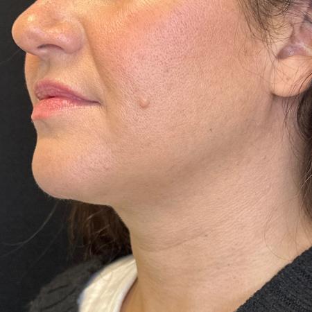 After image 4 Case #108011 - CoolSculpting for Double Chin