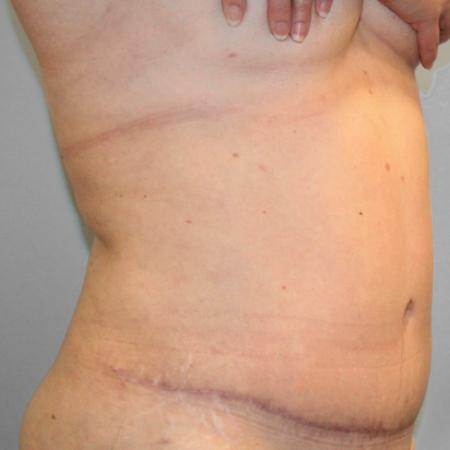 After image 2 Case #107801 - Tummy Tuck