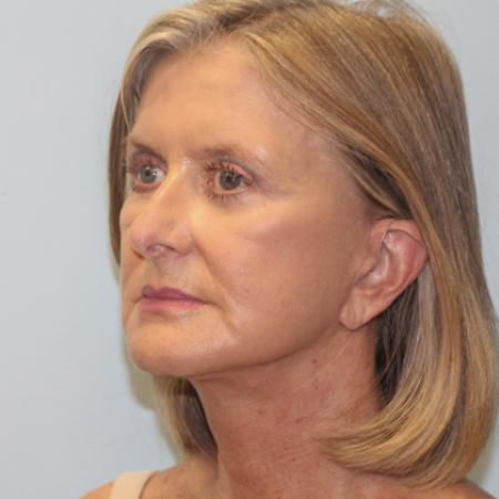 After image 2 Case #108171 - Facelift, Browlift, & Blepharoplasty