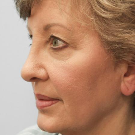 Before image 2 Case #107561 - Blepharoplasty