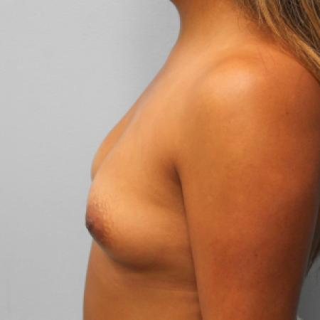 Before image 3 Case #108221 - Breast Augmentation