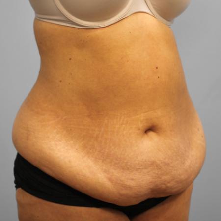 Before image 2 Case #108076 - Tummy Tuck