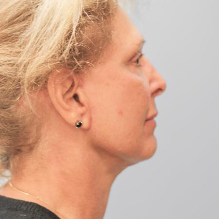 After image 3 Case #108191 - Facelift 