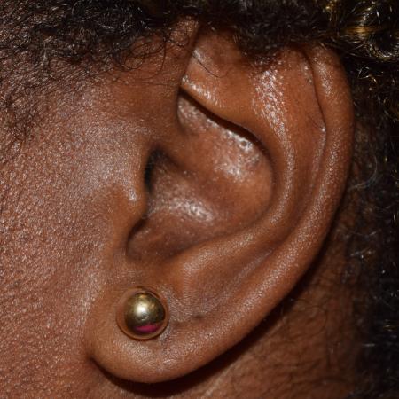 After image 2 Case #107911 - Bilateral Earlobe Repair & Ear Piercing